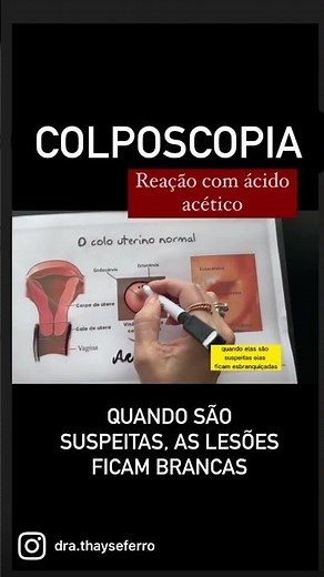 COLPOSCOPIA ENTENDA O EXAME