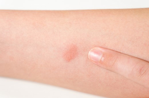 Cara Membaca Hasil Tes Mantoux Untuk Mengetahui Penyebab TBC