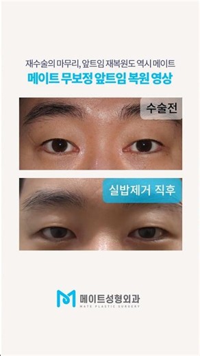 앞트임 재수술 한번에 성공하는 방법! ☺️#앞트임복원 #앞트임재수술 #앞트임재건 #앞트임 #앞트임재수술 #트임재수술 #메이트성형외과 #논현역성형외과