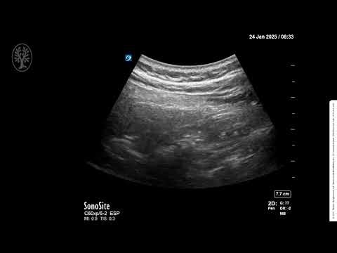 Video 6 1 Lumbar ESP Block Note Ther MedOne, Thieme