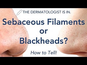 Sebaceous Filaments vs Blackheads | Dermatologist Explains