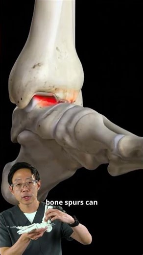Dr Tan Ken Jin Explains Ankle Bone Spurs | #MCAShorts
