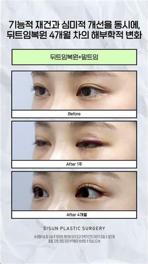 기능적 재건과 심미적 개선을 동시에, 뒤트임복원 4개월 차의 해부학적 변화 #시선성형외과 #shorts
