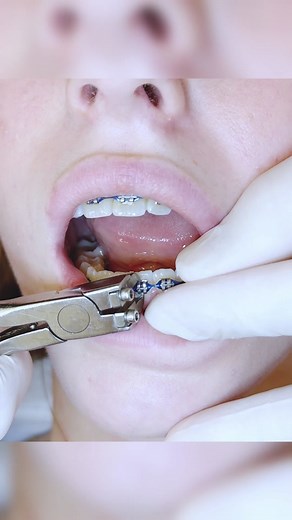 Gimme 12 seconds to get these braces off 🥶