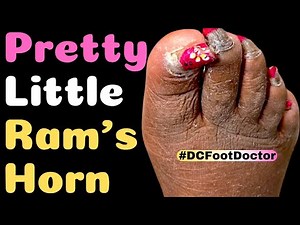 Trimming Ram's Horn Fungal Toenail Deformity: Nail Polish Can’t Hide Under Pretty Little Ram's Horn