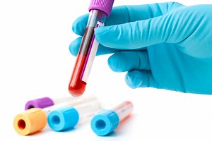 CGA: a laboratory test for the diagnosis of neuroendocrine tumours