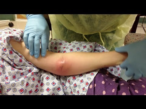 IVDA abscess