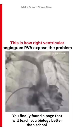 🫀This is how 🧬 right ventricular angiogram RVA 🩸 expose the problem 🩻| MDCT