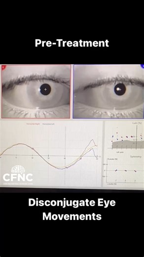 What is a disconjugate eye movement? As adults most of our eye...