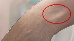 She saw a dent in her wrist where she wore her fitness tracker. What caused it, and how can you prevent it?