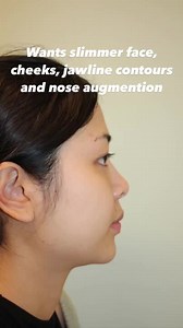 Incredible Transformation: Facial Contouring Surgery Must See