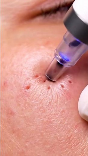 Most Satisfying Blackhead Vacuum Extraction Ever! Real Deep Pore Cleaning ASMR for Stress Relief,