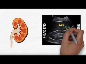 Hydronephrosis on kidney ultrasound