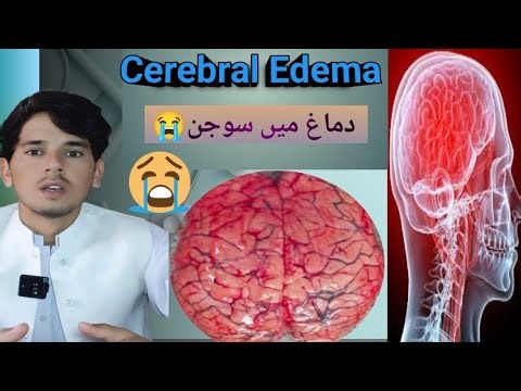 دماغ کی سوجن کیا ہے، یہ کیوں ہوتا ہے، اس کا علاج کیسے کیا جاتا ہے اور آپ اس سے کیسے بچ سکتے ہیں😭😱😱۔