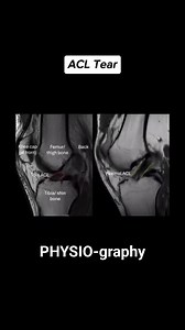 Abnormal knee MRIs | PHYSIO-graphy