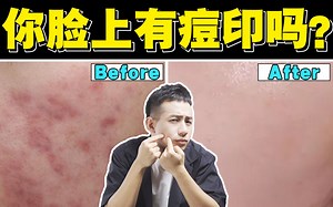 【医学博士】总是手痒抠痘痘怎么办 I 痘印该如何修复？