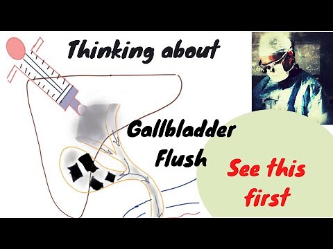 Thinking about Gallbladder Flush? See this first