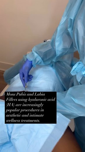 Cosmetic Nurse Alicia on Instagram: "Mons Pubis and Labia Filler ⬇️⬇️⬇️ 1. What Are They? • Mons pubis filler: Enhances the volume and contour of the mons pubis (the fatty area above the pubic bone). • Labia filler: Typically refers to labia majora enhancement, restoring volume lost due to aging, weight loss, or hormonal changes. 2. Why Use Hyaluronic Acid? Hyaluronic acid is: • Biocompatible and naturally found in the body. • Reversible with hyaluronidase if needed. • Temporary, lasting 6–18 mo