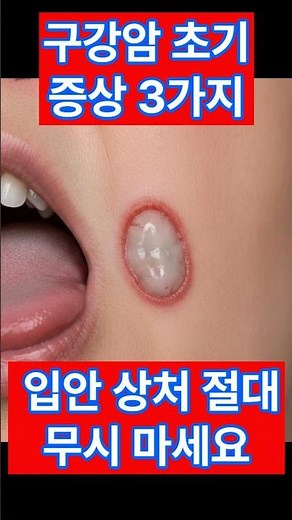 구강암 초기 증상 3가지! 입안 상처 절대 무시 마세요!