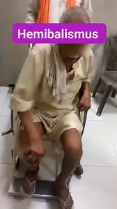 HEMIBALISMUS Hemiballismus, a rare but important neurological movement disorder. It is characterized by sudden, violent, involuntary flinging movements affecting one side of the body, usually involving the arm and leg. Definition Hemiballismus is a hyperkinetic movement disorder marked by: Unilateral (one-sided) Large-amplitude, proximal limb movements Irregular, forceful, flinging or throwing-type motions Clinical Features Patients typically present with: Sudden onset of violent, jerky, flingin