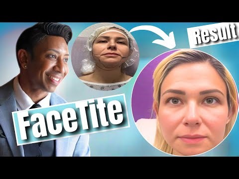 FaceTite changed my life - What REALLY Happens After FaceTite Treatment? Patient Testimonial