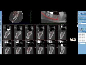This Is Why You Should Take A CBCT For Implant Planning