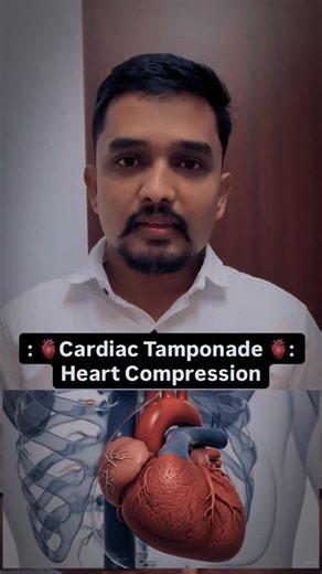 Dr. Udaykumar Mahajan on Instagram: "CARDIAC TAMPONADE – DETAILED MANAGEMENT (ICU Protocol) Cardiac Tamponade is a time-critical emergency. Management = Stabilize → Relieve pressure → Treat cause. ⸻ 🔥 1️⃣ Immediate Stabilization (FIRST 5 MINUTES) ✔ Oxygen Support Maintain SpO₂ > 94%. ✔ Large-bore IV Access (2 lines) Start crystalloids (small boluses) only to maintain preload — do NOT overload. ✔ Continuous Monitoring • ECG • BP (preferably invasive if available) • SpO₂ • Urine output • Mental s