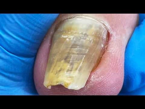 There Are Yellow Patterns In The Toenails, Completely Solved【Pedicure Master Lin Jun】