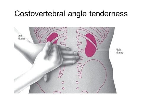 Costovertebral angle tenderness Or Renal Angle Tenderness ; Definition, Causes, Symptoms, Treatment