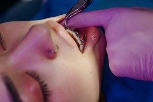 What Does Dental Insurance Not Cover: Key Exclusions to Know