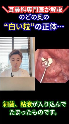 「これ、膿栓です。」😱 のどの奥の白いかたまりを耳鼻科医が解説#膿栓 #耳鼻科 #耳鼻咽喉科 #口臭 #扁桃腺#tonsil #医療解説 #健康情報 #のどの違和感 #膿栓除去