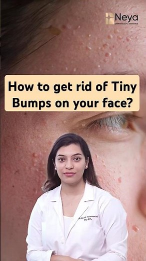 What is Milia on the face | How to treat milia | Dermatologist in Hyderabad