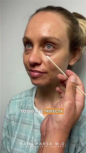 Saying Goodbye to My Eye Bags (Since Early Childhood) | Dr. Kami Parsa Trifecta Lift