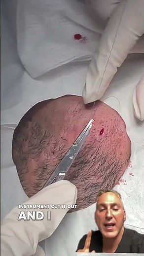 Best Treatment for Ice Pick Scars