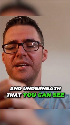 Plantar Plate INJURY [ plantar plate anatomy ]