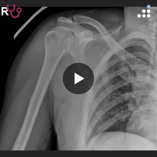 Posterior Shoulder Fracture-Dislocation in 32M | Orthobullets | 50 comments