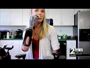 Woman who survived flesh eating bacteria uses an advanced prosthetic system