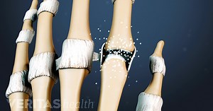 Rheumatoid Arthritis Overview Video