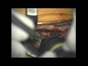 Use of Bone Scalpel - Hemilaminectomy • Video • MEDtube.net