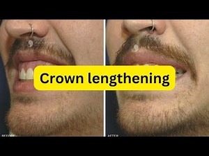 Crown lengthening with steps