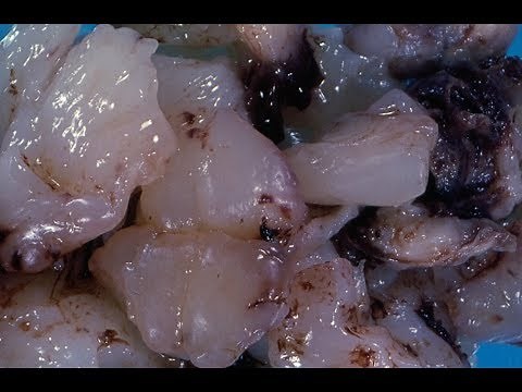 Embryonal Rhabdomyosarcoma - Pathology mini tutorial