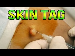 Skin Tag Removal - Dr G Snips Off an Under Arm Papilloma