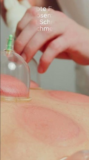 Verklebte Faszien lösen: So hilft Schröpfen bei Schmerzen!