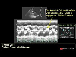 Mitral Stenosis on M Mode Echocardiogram | Echocardiography For Beginners