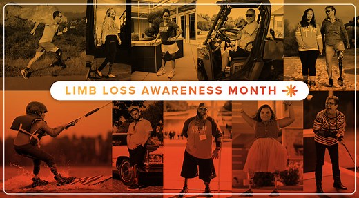 Limb Loss and Limb Difference: Facts, Statistics, & Resources