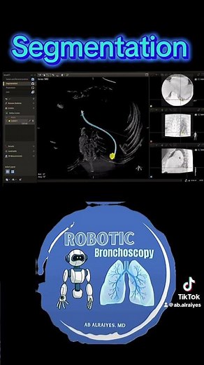 Augmented Fluoroscopy CBCT Segmentation
