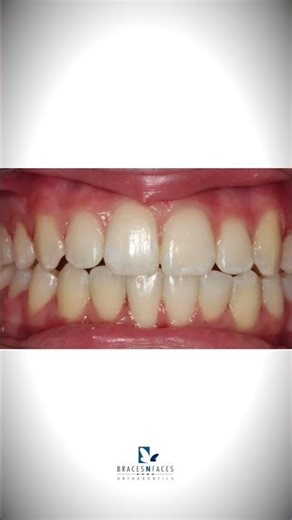 Before & After Teeth Crowding and Crossbite Braces Treatment