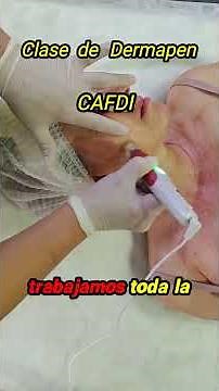 Transforma tu piel con estos secretos del Dermapen