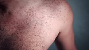 「ヒトの肩に赤いかゆみを伴うにきび皮膚感染症やアレルギー、カメラで肩を掻く男の手、皮膚湿疹、乾癬や脂漏性皮膚炎、敏感な肌のコンセプト。高品質4k」の動画素材（ロイヤリティフリー）3455412987 | Shutterstock