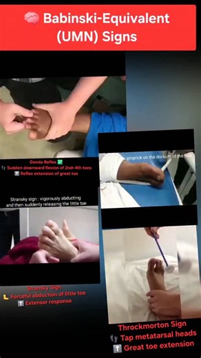 Adeel Ur Rehman on Instagram: "Babinski Alternatives You MUST Know Babinski equivocal? These signs don’t lie ⚠️ ✔️ Gordon ✔️ Bing ✔️ Throckmorton ✔️ Stransky ✔️ Oppenheim ✔️ Chaddock ✔️ Gonda reflex 💡 All trigger the extensor plantar response → UMN lesion 📌 Save this reel — gold for exams, wards & OSCEs 💎 QUICK CLINICAL PEARLS (PIN COMMENT) • All are Babinski equivalents • Useful when plantar response is unclear • Early UMN lesions may show only these • Always correlate with tone & reflexes #